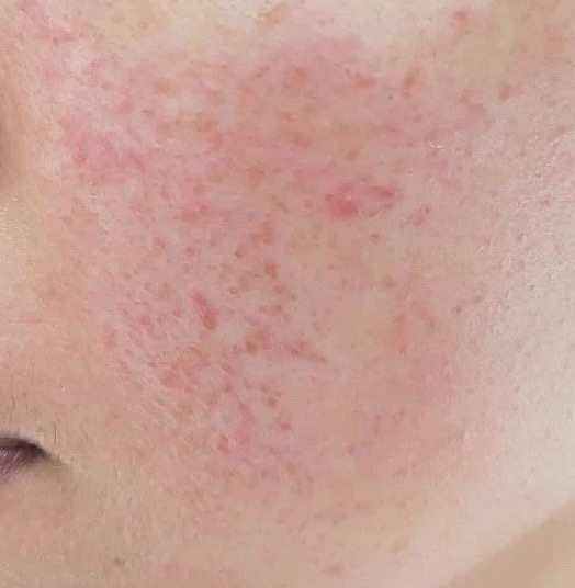 贴甲片引起全身过敏吗