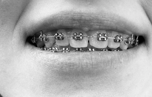 整牙会变好看还是丑